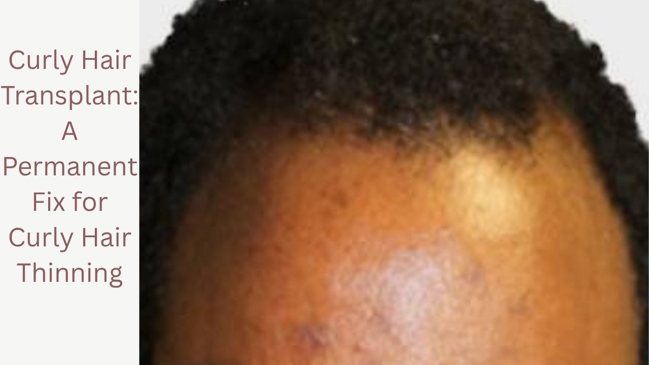 Curly Hair Transplant: A Permanent Fix for Curly Hair Thinning